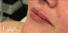 Injectable Fillers After Photo by Munique Maia, MD; Tysons Corner, VA - Case 48749
