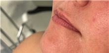 Injectable Fillers Before Photo by Munique Maia, MD; Tysons Corner, VA - Case 48749