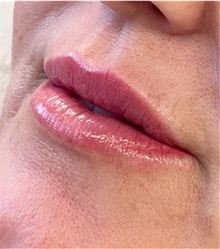 Injectable Fillers After Photo by Munique Maia, MD; Tysons Corner, VA - Case 48750