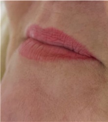 Injectable Fillers Before Photo by Munique Maia, MD; Tysons Corner, VA - Case 48750