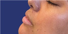 Injectable Fillers Before Photo by Munique Maia, MD; Tysons Corner, VA - Case 48752