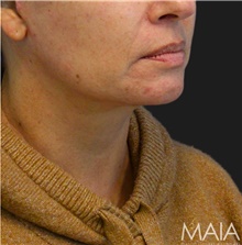 Facelift After Photo by Munique Maia, MD; Tysons Corner, VA - Case 48798