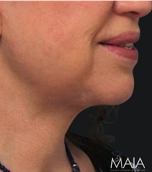 Facelift After Photo by Munique Maia, MD; Tysons Corner, VA - Case 48807