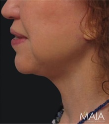 Facelift After Photo by Munique Maia, MD; Tysons Corner, VA - Case 48807