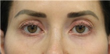 Eyelid Surgery Before Photo by Munique Maia, MD; Tysons Corner, VA - Case 48808