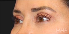 Eyelid Surgery After Photo by Munique Maia, MD; Tysons Corner, VA - Case 48808