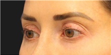 Eyelid Surgery Before Photo by Munique Maia, MD; Tysons Corner, VA - Case 48808