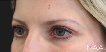 Eyelid Surgery After Photo by Munique Maia, MD; Tysons Corner, VA - Case 48809