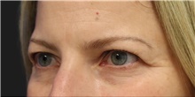Eyelid Surgery Before Photo by Munique Maia, MD; Tysons Corner, VA - Case 48809