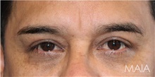 Eyelid Surgery After Photo by Munique Maia, MD; Tysons Corner, VA - Case 48810