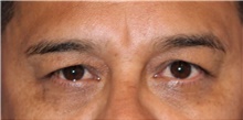 Eyelid Surgery Before Photo by Munique Maia, MD; Tysons Corner, VA - Case 48810