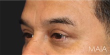Eyelid Surgery After Photo by Munique Maia, MD; Tysons Corner, VA - Case 48810