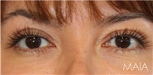 Eyelid Surgery After Photo by Munique Maia, MD; Tysons Corner, VA - Case 48811