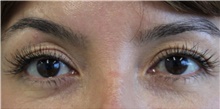 Eyelid Surgery Before Photo by Munique Maia, MD; Tysons Corner, VA - Case 48811