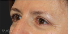 Eyelid Surgery After Photo by Munique Maia, MD; Tysons Corner, VA - Case 48812