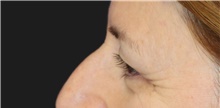 Eyelid Surgery Before Photo by Munique Maia, MD; Tysons Corner, VA - Case 48812