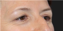 Eyelid Surgery Before Photo by Munique Maia, MD; Tysons Corner, VA - Case 48812