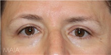 Eyelid Surgery After Photo by Munique Maia, MD; Tysons Corner, VA - Case 48812