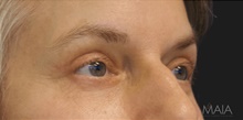 Eyelid Surgery After Photo by Munique Maia, MD; Tysons Corner, VA - Case 48813