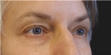 Eyelid Surgery Before Photo by Munique Maia, MD; Tysons Corner, VA - Case 48813