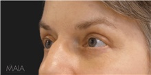 Eyelid Surgery After Photo by Munique Maia, MD; Tysons Corner, VA - Case 48813