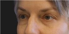 Eyelid Surgery Before Photo by Munique Maia, MD; Tysons Corner, VA - Case 48813