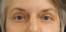 Eyelid Surgery After Photo by Munique Maia, MD; Tysons Corner, VA - Case 48813