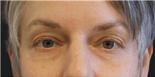 Eyelid Surgery Before Photo by Munique Maia, MD; Tysons Corner, VA - Case 48813