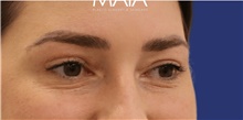 Eyelid Surgery After Photo by Munique Maia, MD; Tysons Corner, VA - Case 48814