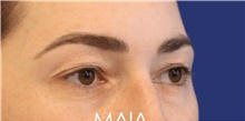 Eyelid Surgery Before Photo by Munique Maia, MD; Tysons Corner, VA - Case 48814