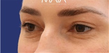 Eyelid Surgery After Photo by Munique Maia, MD; Tysons Corner, VA - Case 48814