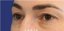 Eyelid Surgery Before Photo by Munique Maia, MD; Tysons Corner, VA - Case 48814