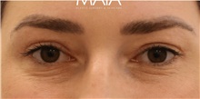 Eyelid Surgery After Photo by Munique Maia, MD; Tysons Corner, VA - Case 48814