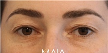 Eyelid Surgery Before Photo by Munique Maia, MD; Tysons Corner, VA - Case 48814