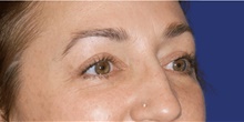 Eyelid Surgery After Photo by Munique Maia, MD; Tysons Corner, VA - Case 48815