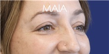 Eyelid Surgery Before Photo by Munique Maia, MD; Tysons Corner, VA - Case 48815