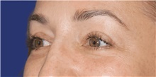 Eyelid Surgery After Photo by Munique Maia, MD; Tysons Corner, VA - Case 48815