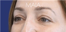 Eyelid Surgery Before Photo by Munique Maia, MD; Tysons Corner, VA - Case 48815