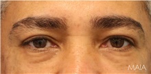 Eyelid Surgery After Photo by Munique Maia, MD; Tysons Corner, VA - Case 48816