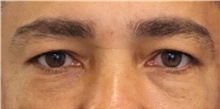 Eyelid Surgery Before Photo by Munique Maia, MD; Tysons Corner, VA - Case 48816