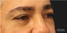 Eyelid Surgery After Photo by Munique Maia, MD; Tysons Corner, VA - Case 48816