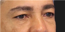 Eyelid Surgery Before Photo by Munique Maia, MD; Tysons Corner, VA - Case 48816