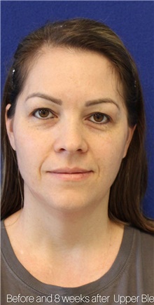 Eyelid Surgery Before Photo by Munique Maia, MD; Tysons Corner, VA - Case 48820