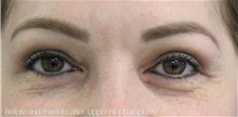 Eyelid Surgery After Photo by Munique Maia, MD; Tysons Corner, VA - Case 48820