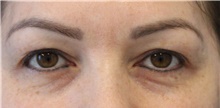 Eyelid Surgery Before Photo by Munique Maia, MD; Tysons Corner, VA - Case 48820