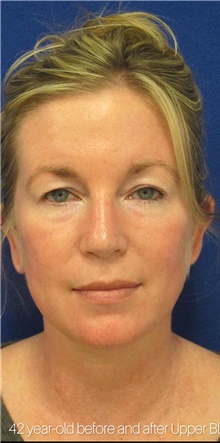 Eyelid Surgery Before Photo by Munique Maia, MD; Tysons Corner, VA - Case 48821