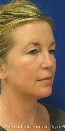 Eyelid Surgery Before Photo by Munique Maia, MD; Tysons Corner, VA - Case 48821