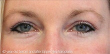 Eyelid Surgery After Photo by Munique Maia, MD; Tysons Corner, VA - Case 48821