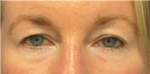 Eyelid Surgery Before Photo by Munique Maia, MD; Tysons Corner, VA - Case 48821