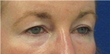 Eyelid Surgery Before Photo by Munique Maia, MD; Tysons Corner, VA - Case 48821